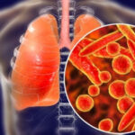 Nghiên cứu đột phá, CMX410 có thể thay thế kháng sinh trong điều trị lao